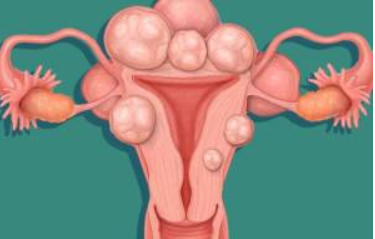 Diagnosed with Fibroid Tumor now what?