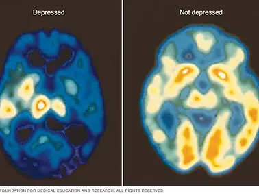 PET Scan of Depression.webp