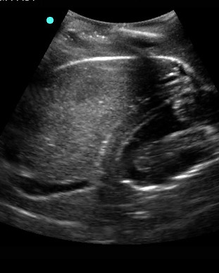 spleen-kidney_fast_exam.jpg