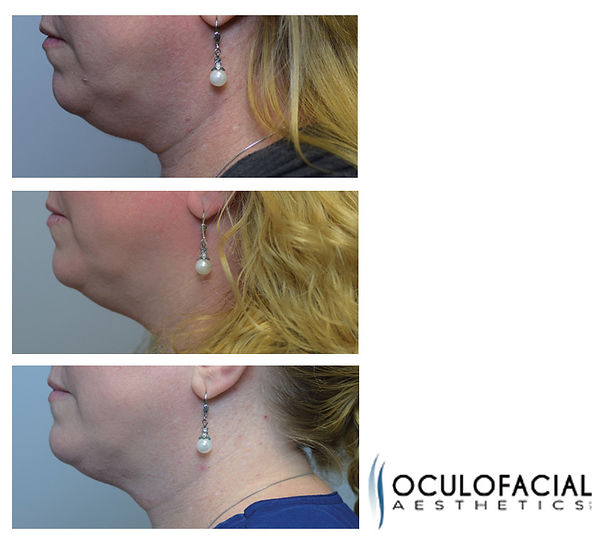 Before and after of Kybella treatment