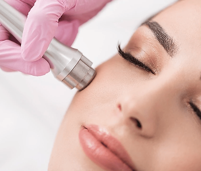 microdermabrasion treatment