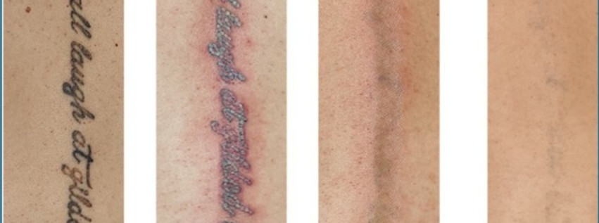 Four-stage progression photos showing tattoo fading from baseline to near-complete removal after laser sessions