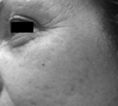 Multi-functional laser treatment before and after for facial pigmentation and wrinkle reduction