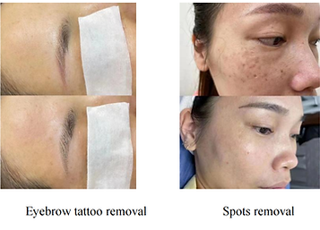 Before and after clinical results of picosecond laser treatment for tattoo removal, spot reduction, and birthmark removal