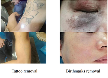 Before and after clinical results of picosecond laser treatment for tattoo removal, spot reduction, and birthmark removal