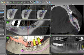 Chirurgia computer guidata.jpg