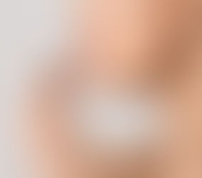 Lip Fillers 101: What to Expect Before, During, and After the Procedure