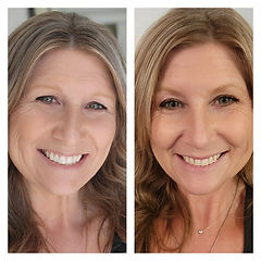 before and after Botox