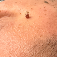 Skin Tag