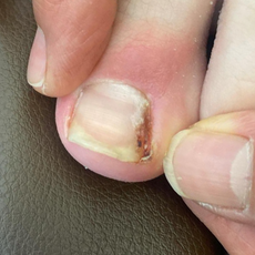 Ingrown nail