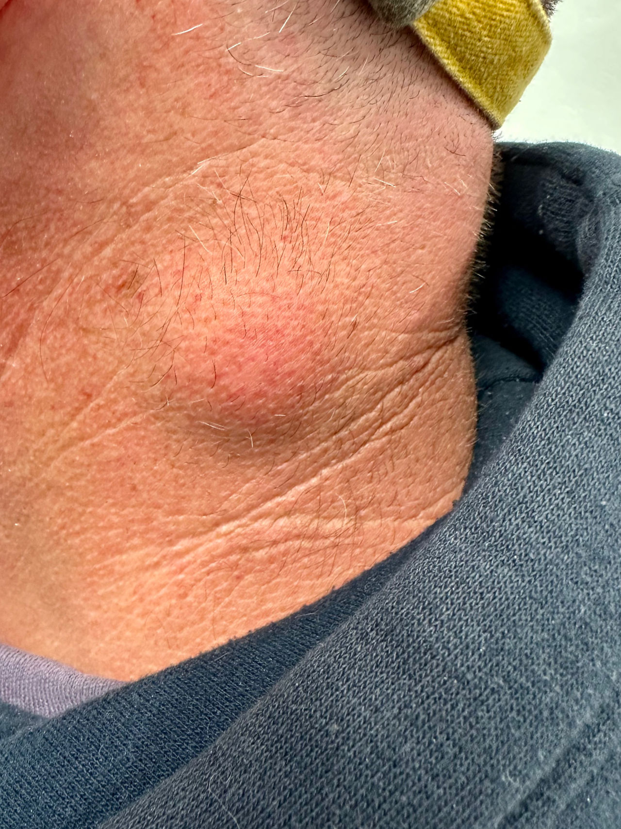 Neck cyst