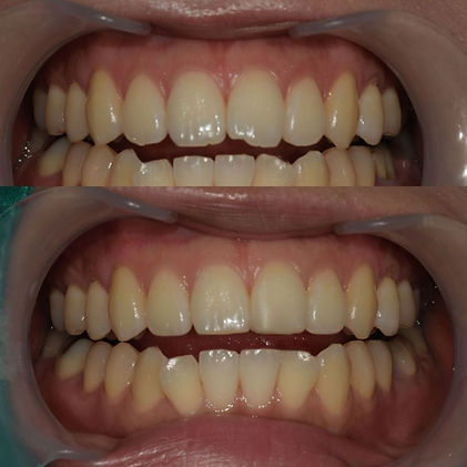 앞니 파절, 레진치료 후기 및   리뷰