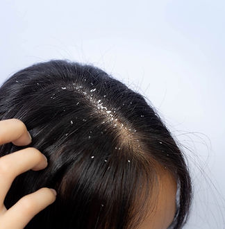 dandruff-and-hair-fall.jpg