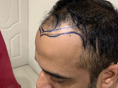 Hairline
