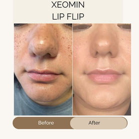 Front view of a Lip Flip done with Botox Xeomin