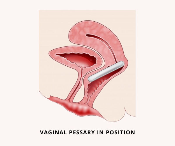Cross-section diagram of a vaginal pessary correctly placed inside the pelvis. Text below reads "VAGINAL PESSARY IN POSITION."