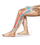 法國 Veinoplus Arterial 腳部動脈血液刺激儀 - 3