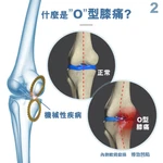 Medex 免負重膝矯形器(O型腳) - 3