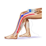 法國Veinoplus V.I. 靜脈曲張電刺激儀 - 3