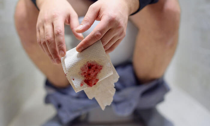 HAEMORRHOIDS: Find out more about these piles of pain and pang.