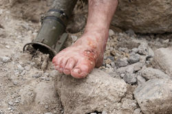 Blisters
