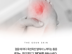 발에서 느껴지는 통증 부산티눈제거