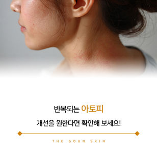 지속적으로 재발하는 아토피 치료를 원한다면?