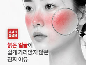 안면홍조가 쉽게 가라앉지 않는 이유에 대해서 알아봅시다.