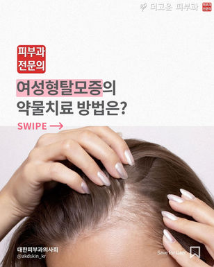 여성형탈모증, 그 원인은?