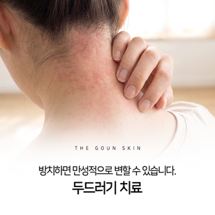 체계적인 관리를 통해 두드러기를 개선해 보시길 바랍니다.