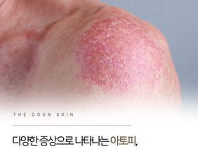 피부에 영원한 흔적으로 남지 않도록 아토피 치료를 받아보시길 바랍니다.