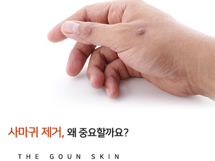 사마귀제거 중요한 이유는?