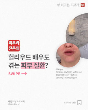 재발이 잦은 피부염과 주사, 적절한 관리와 치료를 받아보세요!