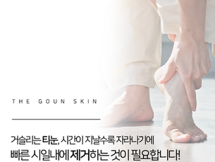 티눈으로 인해 참을 수 없는 통증, 치료가 필요한 상황입니다.