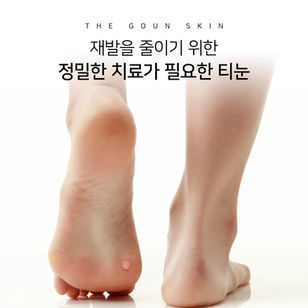 재발이 잦은 티눈, 어떻게 치료할까?