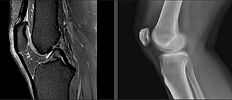 knee mri.JPG
