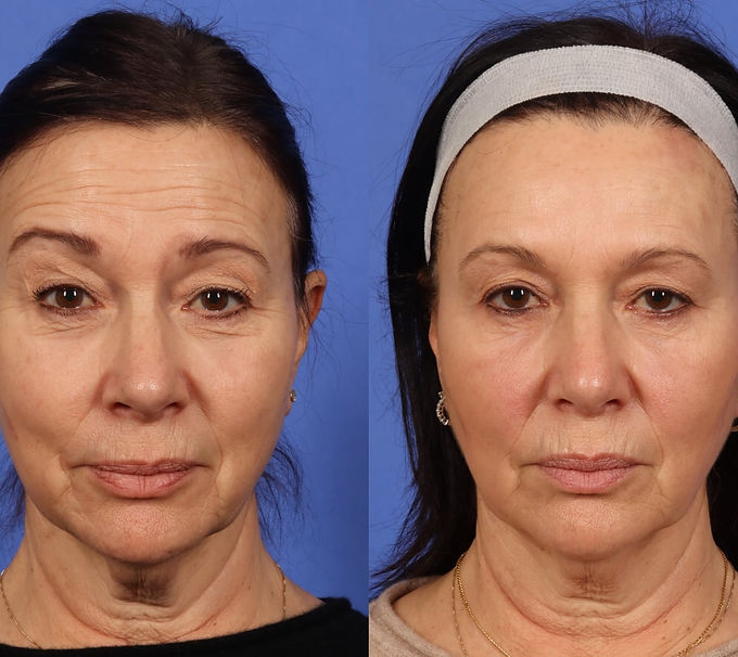 1727716978-botox-photos-1094.jpeg