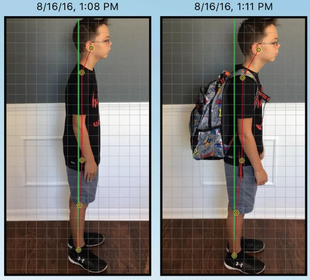 Can Backpacks Cause Spinal Misalignments in Kids?