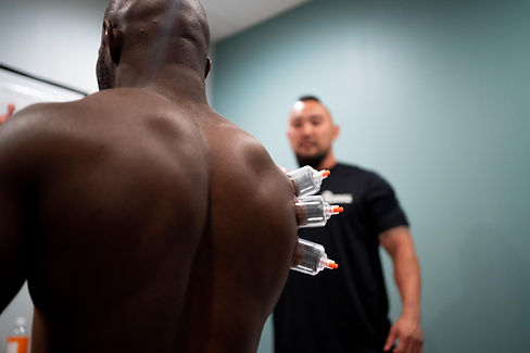 Cupping Technique