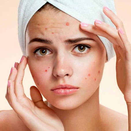 SOP: Quistes en los ovarios o irregularidades menstruales. 