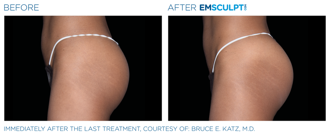Emsculpt Neo before and after female glutes