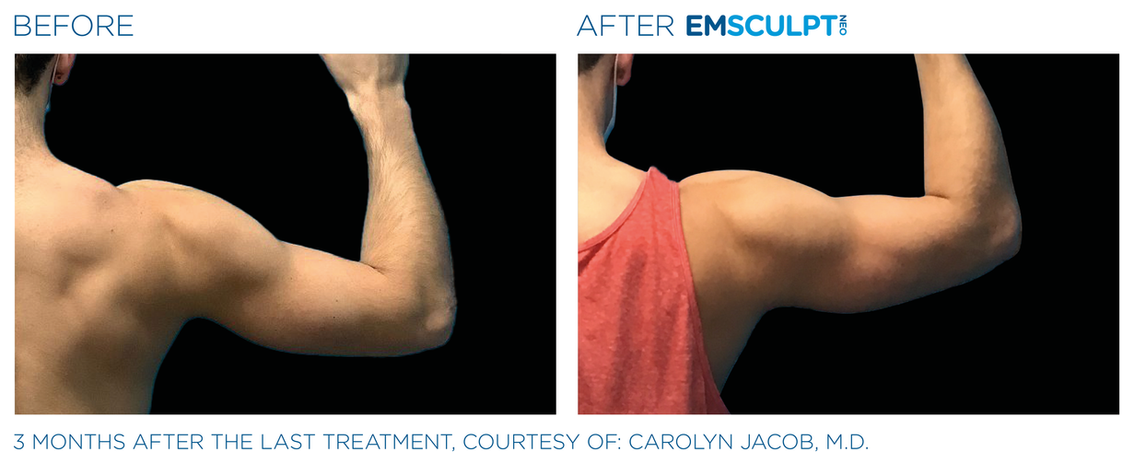 Emsculpt Neo before and after female biceps and triceps