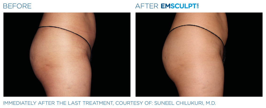 Emsculpt Neo before and after female buttocks