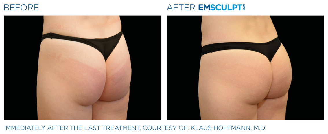 Emsculpt Neo before and after female buttocks