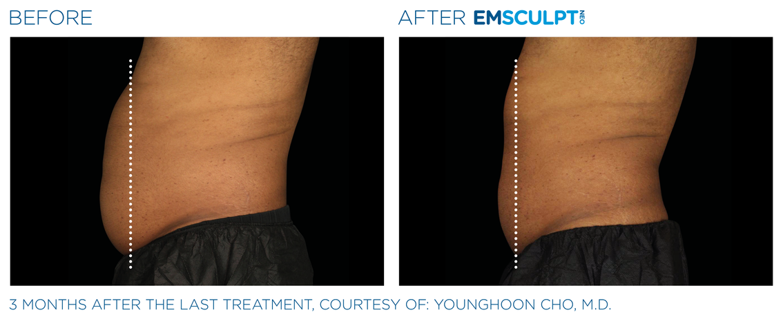 Emsculpt Neo before and after male abdomen