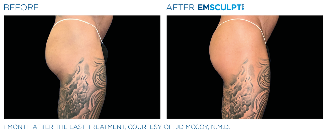 Emsculpt Neo before and after male buttocks and thighs