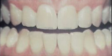 Clareamento Dentario