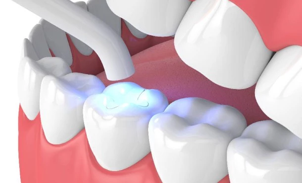 A tooth being filled with composite.