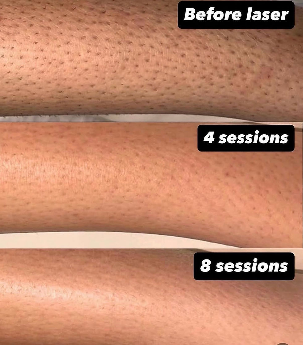 Diode Laser vs IPL Hair Removal: Which Is Better for Your Clinic?