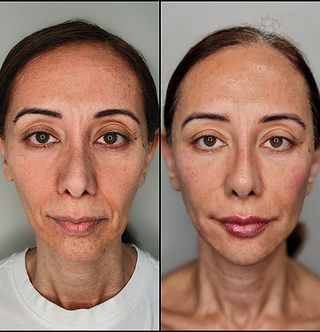 A woman's face showing great improvements and reduced wrinkles after administering dermal fillers